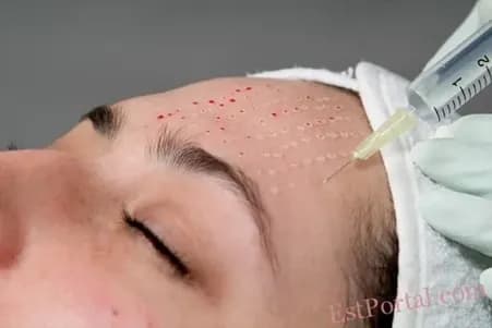 Mesotherapy